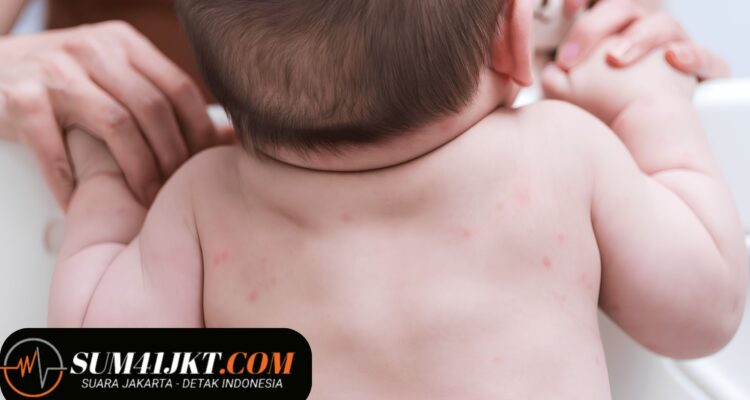 Penyakit Kulit pada Anak yang Perlu Diwaspadai, Kenali Penyebabnya