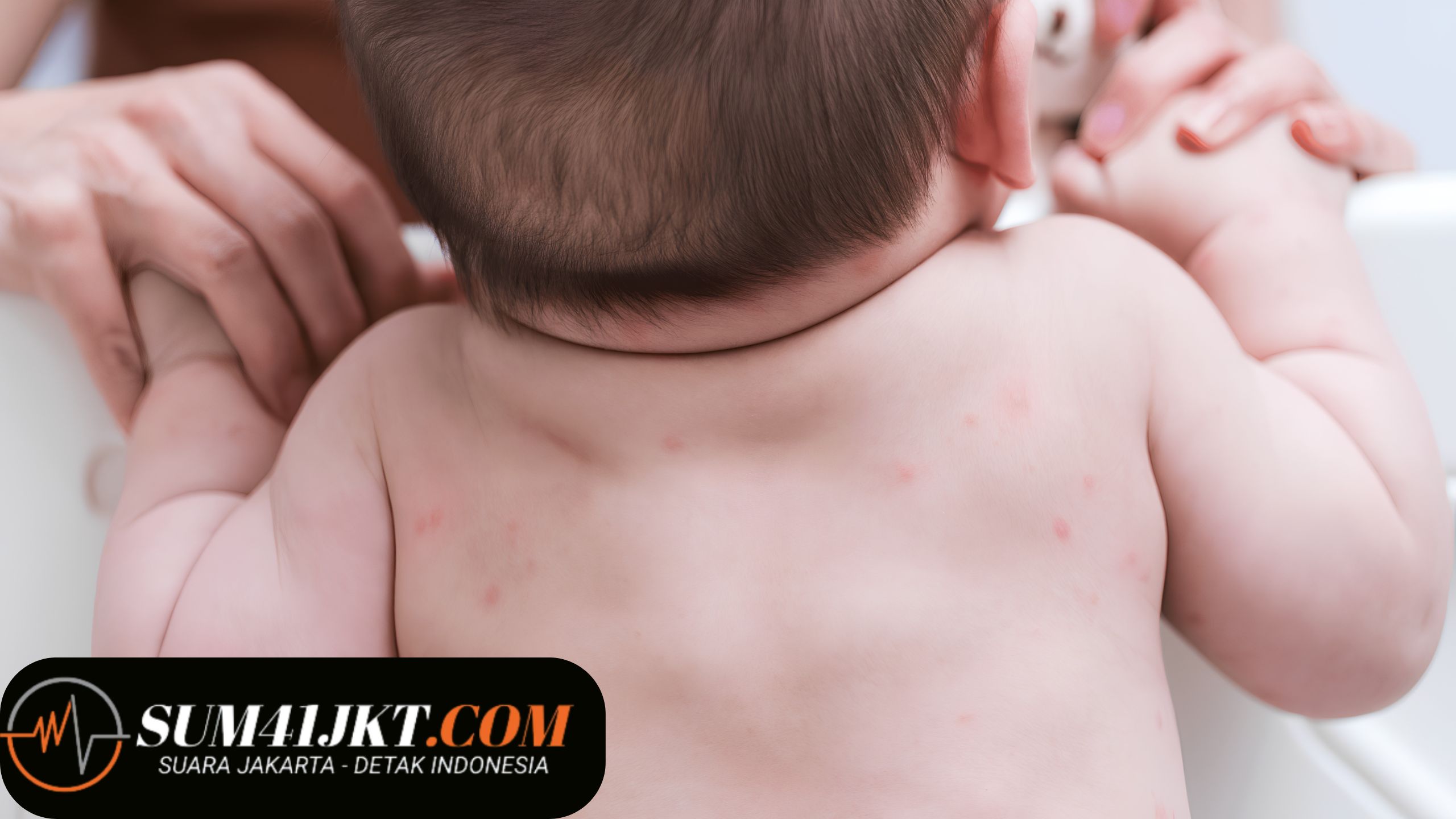 Penyakit Kulit pada Anak yang Perlu Diwaspadai, Kenali Penyebabnya