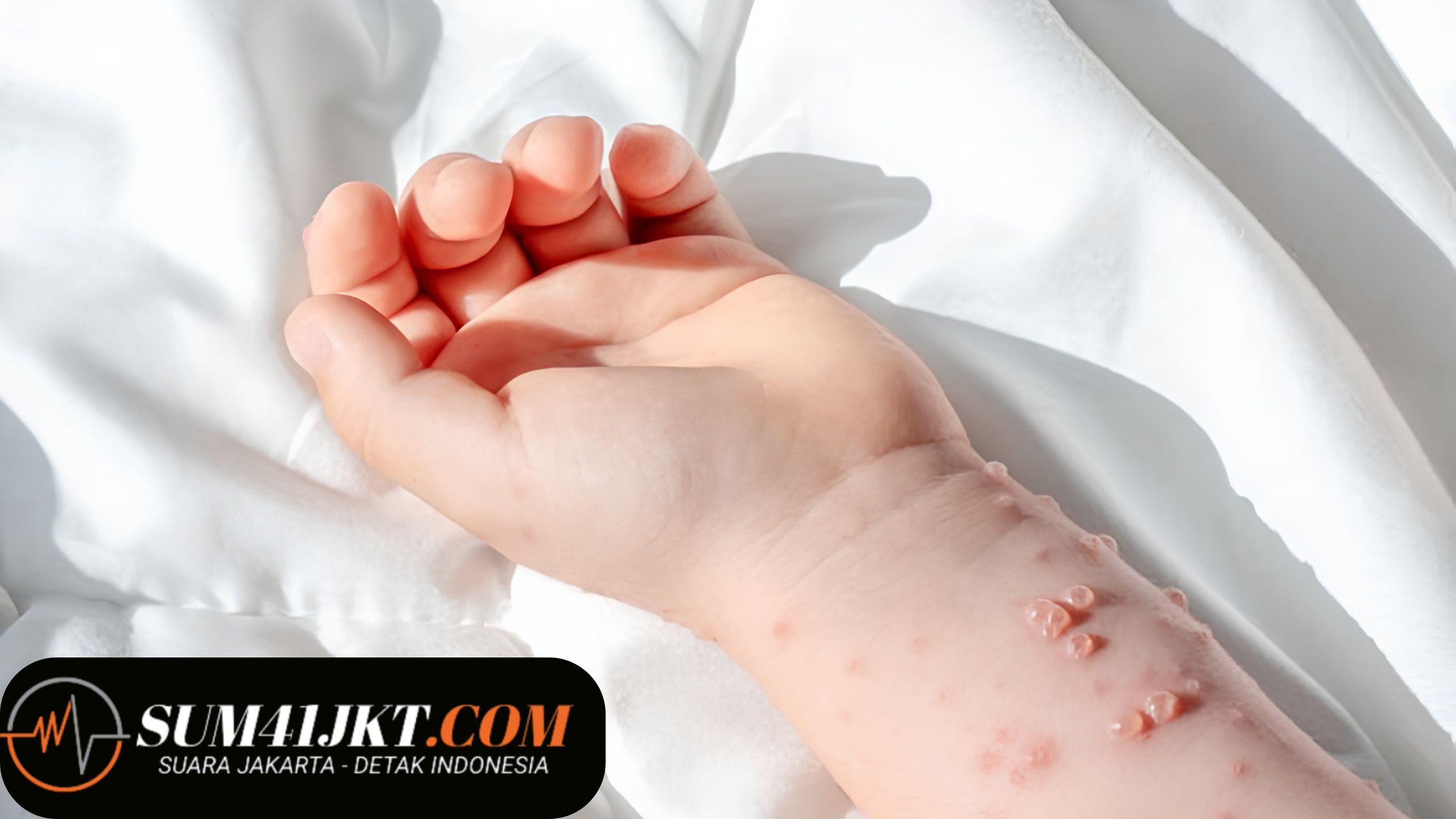 Jenis Penyakit Kulit pada Anak yang Sering Terjadi